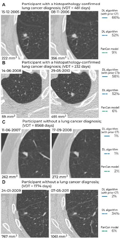 Examples of screening-detected pulmonary nodules from the Danish Lung Cancer Screening Trial (DLCST) and the Multicentric Italian Lung Detection Trial (MILD), wherein malignancy risks were estimated accurately by the deep-learning (DL) algorithm that combines a current and prior CT examination. The lines correspond to the malignancy risk estimation algorithms (solid blue, DL algorithm with prior CT; dotted blue, DL algorithm; dotted green, PanCan model). The percentages correspond to the risk scores from 0% to 100%. (A) Annual low-dose axial chest CT images in a 55-year-old woman with a lung cancer diagnosis in the DLCST show a growing spiculated malignant nodule, with a volume doubling time (VDT) of 481 days. All algorithms produced high malignancy risk scores. (B) Biennial low-dose axial chest CT images in a 67-year-old man with a lung cancer diagnosis in the MILD show a growing malignant nodule (VDT, 232 days). The DL algorithms produced high malignancy risk scores. (C) Annual low-dose axial chest CT images in a 66-year-old male participant without a lung cancer diagnosis in the DLCST show a stable benign nodule in which all algorithms produced low malignancy risk scores. (D) Biennial low-dose axial chest CT images in a 78-year-old male participant without a lung cancer diagnosis in the MILD show a stable part-solid benign nodule, in which the DL algorithm, which combines current and prior CT, produced a low malignancy risk score. However, the algorithm that only processed a single CT produced a high malignancy risk score. Images and caption courtesy of the RSNA.