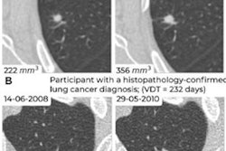 2023 08 02 22 10 8548 2023 08 02 Prior Ct Lung Nodules Figure5 20230802225238