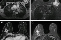 2023 08 02 23 01 3552 2023 08 01 Radiology Mri Breast Radiomics 20230802230019
