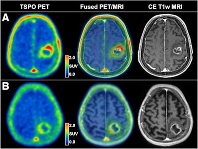 (A) A 76-year-old male patient with left precentral IDH wild-type glioblastoma before hypofractionated radiotherapy and temozolomide chemotherapy. Tumoral TSPO radioligand uptake was high (SUVmax, 2.4), and survival was short (OS, 4.5 months). (B) A 71-year-old female patient with left postcentral parietal IDH wild-type glioblastoma before hypofractionated radiotherapy and temozolomide chemotherapy. Tumoral TSPO radioligand uptake was low (SUVmax, 1.8), and survival was long (OS, 25.8 months). Image and caption courtesy of the Journal of Nuclear Medicine (CC BY 4.0).