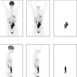 2023 08 15 20 08 2453 2023 08 15 Ai Lymphoma 20230815202323