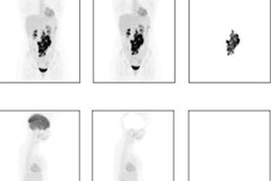 2023 08 15 20 08 2453 2023 08 15 Ai Lymphoma 20230815202323