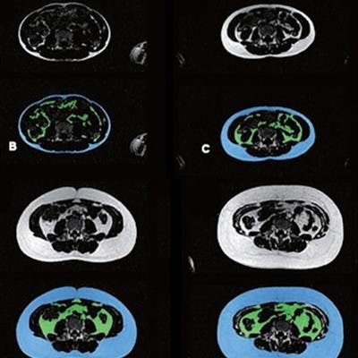 2023 08 16 23 13 9567 2023 08 16 Mri Childhood Obesity Figure3 Abcdef 20230816231034