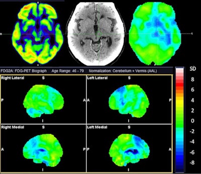 Cerebral F-18 FDG-PET of a 73-year-old man with overlapping features of corticobasal degeneration (CBD) and progressive supranuclear palsy (PSP). The top row shows axial sections at the level of the basal ganglia and mesencephalon of F-18 FDG, CT, and statistical maps. The bottom rows show statistical surface projections with standard deviations from healthy subjects. Note the asymmetry and involvement of the basal ganglia pointing towards CBD and the involvement of mesencephalon and mesial frontal cortex pointing towards PSP. Image and caption courtesy of EJNMMI Research through CC BY 4.0.