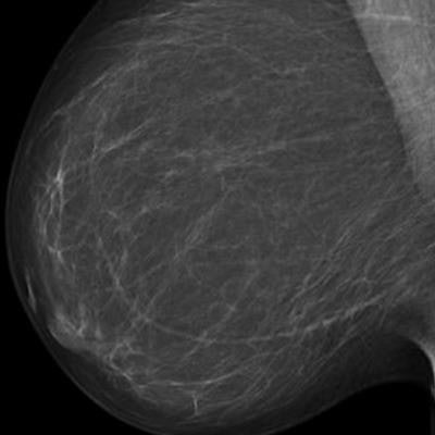 2023 08 29 22 46 1547 2023 08 29 Radiology Ai Mammo 20230829220219