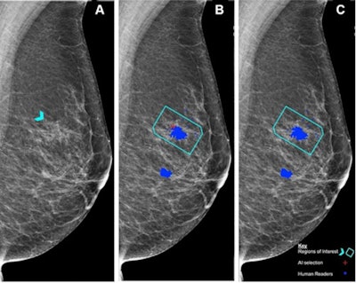 (A) Left mediolateral oblique mammogram. Unadulterated mammogram shows an asymmetric density (arrowhead) which, after biopsy, was determined to be a histologic grade 2 ductal carcinoma. (B) AI has correctly marked the region of interest in the left breast for recall (red cross) when set at a recall threshold of 2.91 or higher to match average human specificity, demonstrating a true-positive case. (C) AI has not marked the region of interest in the same breast when set at a recall threshold of 3.06 or higher, indicating a false-negative case. Blue dots indicate findings identified by the human readers. This shows how modifying the threshold for recall can impact the sensitivity of the AI model. Source: Personal Performance in Mammographic Screening via Yan Chen. Images and caption courtesy of the RSNA.