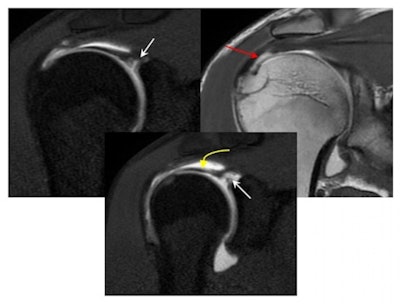 After lifting weights at the gym, a 33-year-old man presented with a partial articular supraspinatus tendon avulsion (PASTA) with superior labral anterior posterior (SLAP) tear. Coronal T1 and T1-weighted fat-saturated MRI arthrogram demonstrates a Type II SLAP tear; contrast entered the space between the superior labrum, with both vertical and horizontal component insinuating anteriorly towards the biceps tendon (straight white arrows). The biceps tendon is intact (yellow curved arrow). Also, note the PASTA lesion with tendon failure on the articular side of the supraspinatus tendon (red arrow).