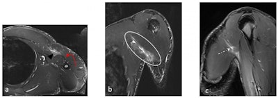 A 27-year-old man presented with a pectoralis major muscle injury, following a weight-training session in the gym. (a) Axial, (b) Coronal, and (c) Sagittal STIR images. Partial tear is visible at the myotendinous junction (black arrowhead and circle), mostly involving the sternal head with muscle fiber retraction. Edema is noted at the distal muscle fibers (white dashed arrow) but no complete tears. Preserved common tendon insertion at the humerus (red arrow).
