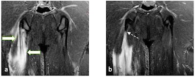 23-year-old male footballer with right semimembranosus muscle longitudinal split tear. (a) and (b) Coronal T2-weighted fat-saturated MRI of pelvis shows feathery edema in bipennate muscle fibers (arrows) converging on central tendon (white solid arrows). This demonstrates longitudinal split, with the proximal extent of tear extending almost up to the level of ischial tuberosity (white dashed arrow).
