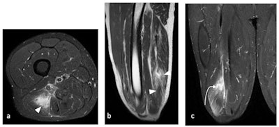 Biceps femoris muscle tear in a 35-year-old male footballer. (a) Axial T2-weighted fat-saturated, (b) Sagittal T2-weighted, and (c) Coronal T2-weighted fat-saturated MRI of pelvis demonstrates interstitial edema within the long head of the biceps femoris muscle (white arrowheads) with an area of fluid-signal intensity (white curved arrow). Note the interruption of the muscle and intramuscular tendon, representing muscle laceration reaching the medial myofascial surface. All images courtesy of Dr. Cleofina Furtado, Dr. Rania Zeitoun et al, and EPOS/European Society of Radiology (ESR).