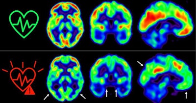 The image represents glucose uptake in the brain measured by positron emission tomography in middle-aged individuals with low (top) or high (bottom) sustained cardiovascular risk over five years. The colors represent cerebral glucose consumption, with red indicating higher consumption and blue lower consumption. Image courtesy of the Spanish National Center for Cardiovascular Research in Madrid (CNIC).