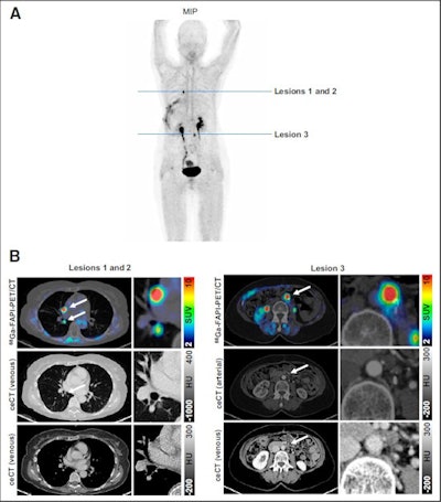 (A) Maximum-intensity projection (MIP) of Ga-68 FAPI-PET. (B) Axial Ga-68 FAPI-PET/CT images and contrast-enhanced CT images of suggestive lesions (arrows: lesions 1 and 2, pulmonary metastasis and mediastinal lymph node metastasis; lesion 3, paraaortic lymph node metastasis) detected by Ga-68 FAPI-PET. HU (Hounsfield units). Image courtesy of the Journal of Nuclear Medicine through CC BY 4.0.