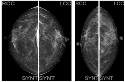 Standard algorithm versus low-dose algorithm in tomosynthesis.