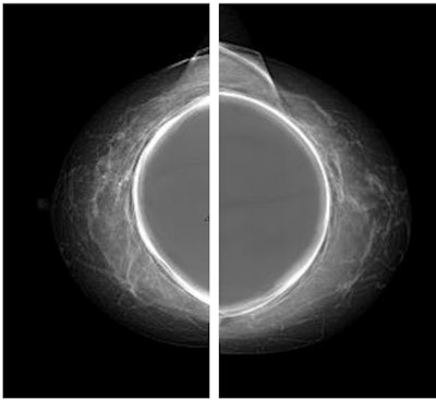 Craniocaudal (CC) view full-field digital mammography of patient with breast implants using the exposure control algorithm.