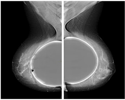 Mediolateral oblique (MLO) view full-field digital mammography of patient with breast implants using the exposure control algorithm. All figures courtesy of Roberta Fedele, Enrico Pofi, et al and presented at EuroSafe 2023.