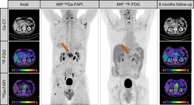 2023 11 20 Fapi Pancreatic