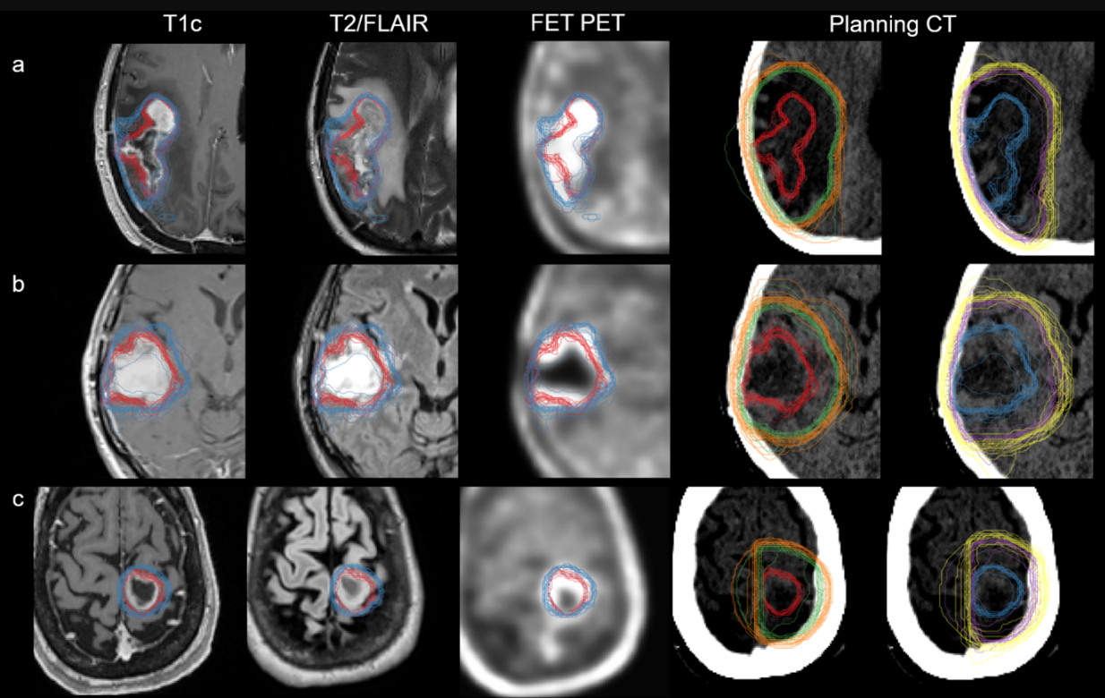 An overview of all radiation oncology target volume delineations on axial imaging. Each row represents the benchmarking cases: FET-PET11 case 1 (a), FET-PET1 case 2 (b), and FET-PET1 case 3 (c). Shown here are standard gross tumor volume MRI (GTVMR, red), clinical target volume MRI (CTVMR, green), planning target volume MRI (PTVMR, orange), and hybrid GTVMR+FET (blue), CTVMR+FET (purple), PTVMR+FET (yellow). For comparison, GTVMR and GTVMR+FET are shown together with contrast-enhanced T1-weighted imaging, T2/FLAIR, and FET-PET. All images are co-registered to each case; respective planning CT where TVMR and TVMR+FET are displayed separately. Figure courtesy of Nathaniel Barry et al and presented at RANZCR ASM 2023.