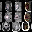 An overview of all radiation oncology target volume delineations on axial imaging. Each row represents the benchmarking cases: FET-PET11 case 1 (a), FET-PET1 case 2 (b), and FET-PET1 case 3 (c). Shown here are standard gross tumor volume MRI (GTVMR, red), clinical target volume MRI (CTVMR, green), planning target volume MRI (PTVMR, orange), and hybrid GTVMR+FET (blue), CTVMR+FET (purple), PTVMR+FET (yellow). For comparison, GTVMR and GTVMR+FET are shown together with contrast-enhanced T1-weighted imaging, T2/FLAIR, and FET-PET. All images are co-registered to each case; respective planning CT where TVMR and TVMR+FET are displayed separately. Figure courtesy of Nathaniel Barry et al and presented at RANZCR ASM 2023.