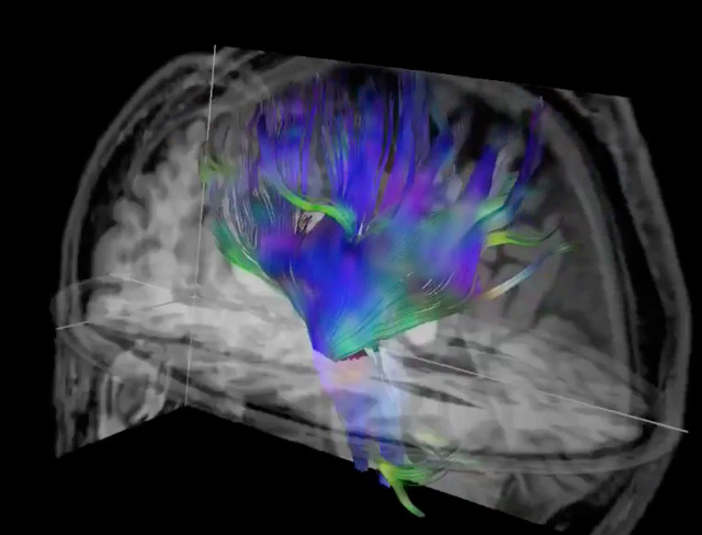 Researchers used diffusion tensor imaging, an MRI technique, to study the impact of football heading on the brain. This method tracks the microscopic movement of water molecules through brain tissue to characterize the brain's microstructure. Image and caption courtesy of the RSNA.