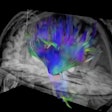 Researchers used diffusion tensor imaging, an MRI technique, to study the impact of football heading on the brain. This method tracks the microscopic movement of water molecules through brain tissue to characterize the brain's microstructure. Image and caption courtesy of the RSNA.