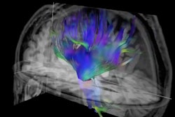 Researchers used diffusion tensor imaging, an MRI technique, to study the impact of football heading on the brain. This method tracks the microscopic movement of water molecules through brain tissue to characterize the brain's microstructure. Image and caption courtesy of the RSNA.