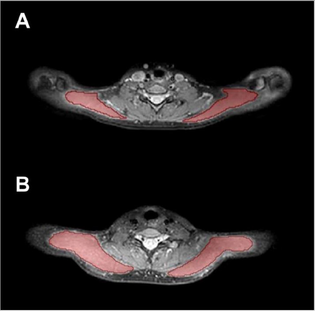 2023 11 29 Quantitative Mri Headache