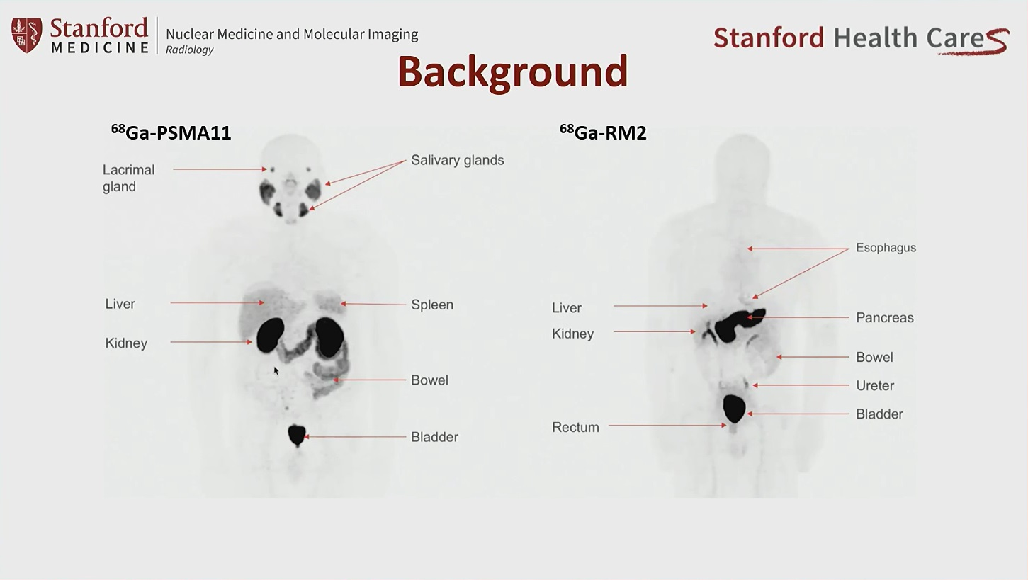 PET tracer shows promise in prostate cancer patients | AuntMinnieEurope
