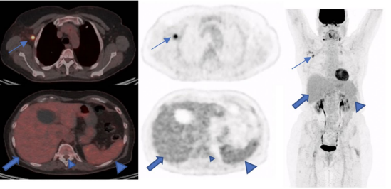 A 73-year-old woman with a suspicious lung nodule was referred to our division for F-18 FDG PET/CT exam. She was vaccinated four days before PET/CT. The lung nodule did not show any pathological FDG uptake; however, high tracer activity was detected on her right arm, where she was injected, and multiple hypermetabolic lymph nodes in the right axilla (arrows). Moreover, PET/CT showed high tracer activity in the liver (black arrows), spleen (triangular arrows), and bone marrow (small triangular arrows) as the result of systemic immune response after vaccination. The tracer defect in the liver was due to the known cyst. (A) fusion scan, (B) PET, (C) maximum intensity projection. Image courtesy of Scientific Reports.