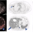 A 73-year-old woman with a suspicious lung nodule was referred to our division for F-18 FDG PET/CT exam. She was vaccinated four days before PET/CT. The lung nodule did not show any pathological FDG uptake; however, high tracer activity was detected on her right arm, where she was injected, and multiple hypermetabolic lymph nodes in the right axilla (arrows). Moreover, PET/CT showed high tracer activity in the liver (black arrows), spleen (triangular arrows), and bone marrow (small triangular arrows) as the result of systemic immune response after vaccination. The tracer defect in the liver was due to the known cyst. (A) fusion scan, (B) PET, (C) maximum intensity projection. Image courtesy of Scientific Reports.