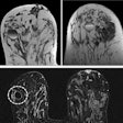 Fat-fluid levels sign: T1- and T2-weighted MRI shows cyst with thin septa, heterogeneous content, and fat-fluid levels, which is compatible with fat content, suggestive of galactocele. A cystic mass with a fat-fluid level is a diagnostic indicator of a galactocele, with the fat content above and the water content remaining at the bottom.