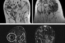 Fat-fluid levels sign: T1- and T2-weighted MRI shows cyst with thin septa, heterogeneous content, and fat-fluid levels, which is compatible with fat content, suggestive of galactocele. A cystic mass with a fat-fluid level is a diagnostic indicator of a galactocele, with the fat content above and the water content remaining at the bottom.