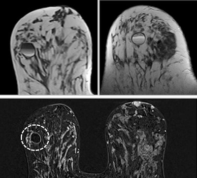 Fat-fluid levels sign: T1- and T2-weighted MRI shows cyst with thin septa, heterogeneous content, and fat-fluid levels, which is compatible with fat content, suggestive of galactocele. A cystic mass with a fat-fluid level is a diagnostic indicator of a galactocele, with the fat content above and the water content remaining at the bottom.
