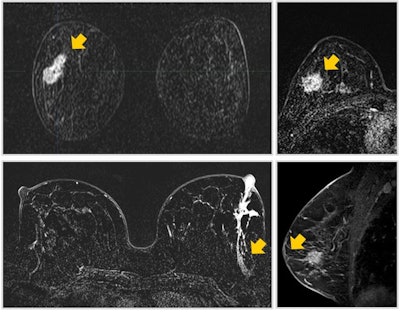Comet sign: A lesion with enhancement characteristics that typically exhibits a 'tail' that extends into the parenchyma, frequently oriented toward the nipple, resembling the tail of a comet. When a 'comet tail' emerges from an enhanced lesion, it serves as a robust indicator of early ductal carcinoma in situ, particularly when it points toward the nipple or aligns with the ductal system. Less probable scenarios, which can be readily discerned from the patient's medical history, include previous biopsies or surgeries in the preceding months. All images courtesy of Dr. Karina Pesce, PhD, and presented at RSNA 2023.