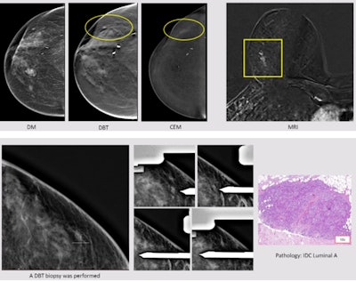A 55-year-old woman with a previous left mastectomy and right tumorectomy in 2010 (ductal carcinoma in situ, DCIS) had a recent diagnosis of positive right axillary lymph node (metastases from invasive ductal carcinoma, IDC). Digital mammography, DBT, and ultrasound were normal, but CEM showed a nonmass enhancement in the inferior outer quadrant (circle). On DBT, a subtle distortion was found in correlation with CEM/MRI (square). A DBT-guided biopsy was performed, leading to a diagnosis of IDC luminal A. All images courtesy of Dr. César Urtasun Iriarte et al and presented at RSNA 2023.