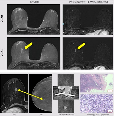 A 48-year-old woman diagnosed with Hodgkin lymphoma in 1999 and treated with chemotherapy and radiotherapy. Ultrasound was normal. MRI follow-up showed a new nonmass enhancement in the right breast (yellow arrow). DBT showed a focal asymmetry. Good correlation with the MRI finding. A DBT-guided vacuum-assisted biopsy was performed, leading to a diagnosis of mucosa associated lymphoid tissue (MALT) lymphoma.