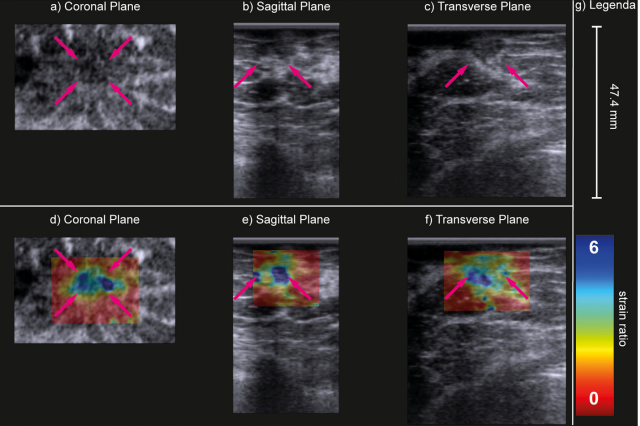 B-mode (a&ndash;c) and strain ratio (d&ndash;f) images of a carcinoma of unknown type in the coronal (a, d), sagittal (b, e) and transverse (c, f) planes. In the strain images (d&ndash;f), the maximal principal strain ratios are superimposed on the B-mode images of the top row. The purple arrows indicate the lesion. Image courtesy of Ultrasound in Medicine & Biology. Image available for fair use under creative commons license.