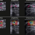 B-mode (a–c) and strain ratio (d–f) images of a carcinoma of unknown type in the coronal (a, d), sagittal (b, e) and transverse (c, f) planes. In the strain images (d–f), the maximal principal strain ratios are superimposed on the B-mode images of the top row. The purple arrows indicate the lesion. Image courtesy of Ultrasound in Medicine & Biology. Image available for fair use under creative commons license.