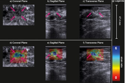 B-mode (a–c) and strain ratio (d–f) images of a carcinoma of unknown type in the coronal (a, d), sagittal (b, e) and transverse (c, f) planes. In the strain images (d–f), the maximal principal strain ratios are superimposed on the B-mode images of the top row. The purple arrows indicate the lesion. Image courtesy of Ultrasound in Medicine & Biology. Image available for fair use under creative commons license.