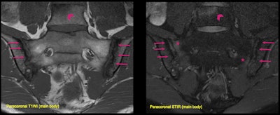 A 36-year-old man presented with lower back pain. Structural lesions are visible in paracoronal T1-weighted imaging (T1WI), including erosions and subchondral sclerosis (arrows). Paracoronal STIR in the same patient shows subchondral edema (asterisks), consistent with active inflammation. Note that the changes are bilateral and symmetrical, but more severe at the iliac sides of the joints. There is also an inflammatory Romanus lesion at the anterior corner of the L5 vertebral body (arrowheads) with an erosion and adjacent bone marrow edema. These findings together suggest ankylosing spondylitis. Remember to look at the main body for inflammatory disorders. All images courtesy of Dr. José Acosta Batlle et al and presented at RSNA 2023.