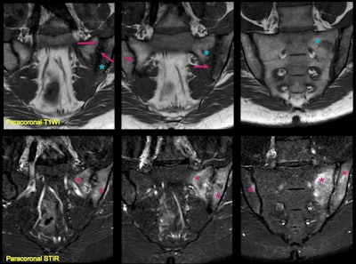 A 35-year-old woman presented with lower back pain, human leukocyte antigen B27+, and increased polymerase chain reaction. Paracoronal STIR shows extensive subchondral edema (asterisks) and increased signal intensity in the inter-articular line, reflecting effusion and synovitis in the left sacroiliac joint (SIJ); all consistent with active inflammation. Note that the changes are bilateral and asymmetrical with predominance of inflammatory changes in the left joint. Paracoronal T1WI shows structural including erosions, subchondral sclerosis (arrows), and early joint space loss. Note that some areas of osteitis/bone marrow edema are low signal in T1WI (blue asterisk), but not as low as sclerosis. Structural and inflammatory lesions can coexist, and SIJ involvement can sometimes be asymmetric or unilateral.