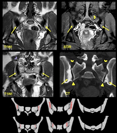A 25-year-old woman presented with lower back pain and a history of two pregnancies. MRI shows areas of sclerosis (arrows) with low signal intensity on T1WI that arise along the iliac surface with bilateral and symmetric affection. CT shows triangular shape of the iliac bone sclerosis and lack of joint erosions. Note there is no joint space narrowing (triangle) in respect of the ligamentous compartment (arrowheads).