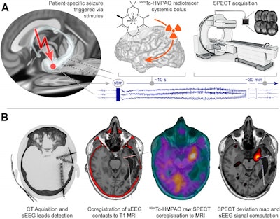 Schematic of triggered ictal SPECT and data processing. (A) Previously screened and selected sEEG bipolar contact is stimulated to trigger patient-typical seizure. Directly after seizure onset, confirmed through sEEG signals and semiology, systemic bolus of radiotracer (Tc-99m HMPAO) is administered. Planned SPECT is acquired within less than one hour. (B) Raw data processing from left to right (dataset from participant three as example). Postimplantation CT and preimplantation T1-weighted MRI are coregistered for sEEG lead localization. Raw SPECT images are coregistered to T1-weighted MRI sequence. SPECT deviation map is computed and anatomically colocalized with sEEG signals. Image courtesy of the Journal of Nuclear Medicine.