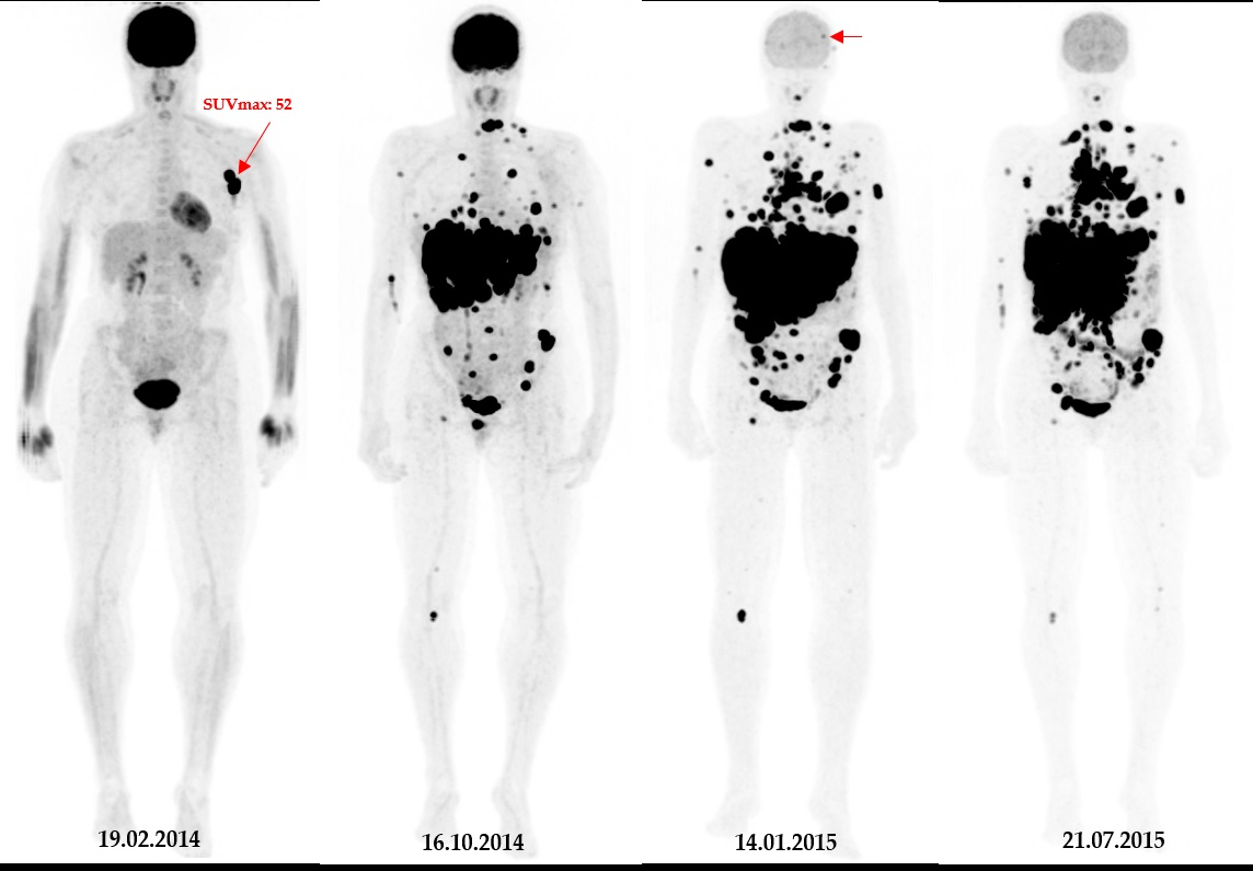 A 49-year-old patient with primary clinical stage III melanoma underwent F-18 FDG-PET. The primary tumor Breslow thickness was 6.5 mm. On initial F-18 FDG-PET images, this patient had a high SUVmax (52), resulting in limited survival with the occurrence of brain metastasis in the first year of follow-up (horizontal arrow). Notably, during the course of the treatment, the patient underwent surgical removal of the primary tumor as well as lymph node dissection, followed by neoadjuvant radiotherapy and immunotherapy. Image courtesy of Cancers.