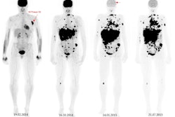 A 49-year-old patient with primary clinical stage III melanoma underwent F-18 FDG-PET. The primary tumor Breslow thickness was 6.5 mm. On initial F-18 FDG-PET images, this patient had a high SUVmax (52), resulting in limited survival with the occurrence of brain metastasis in the first year of follow-up (horizontal arrow). Notably, during the course of the treatment, the patient underwent surgical removal of the primary tumor as well as lymph node dissection, followed by neoadjuvant radiotherapy and immunotherapy. Image courtesy of Cancers.