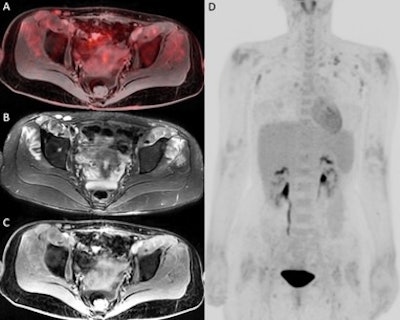 In an example image from the study, F-18 FDG-PET/MRI fusion image (A) and PET 3D image (D) show a moderately increased FDG uptake in muscles around hip joints. T2 IDEAL WATER image (B) shows increased T2 signal; LAVA WATER (C) image shows mild enhancement in these muscles. Findings were suspicious of myositis, which was histopathologically confirmed. Image courtesy of the European Journal of Radiology.