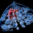 Breast Cancer
