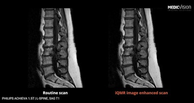 An example of an MRI scan enhanced by Medic Vision's iQMR software. Image courtesy of Medic Vision.
