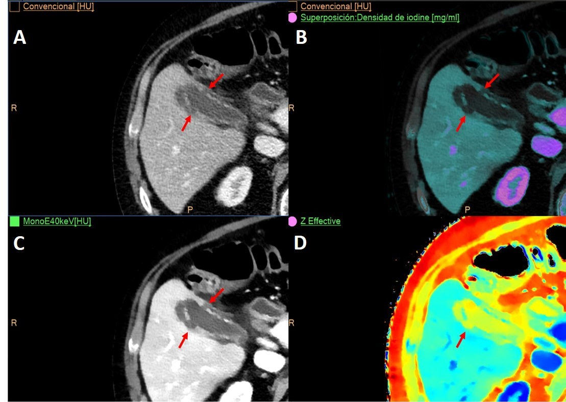 A 61-year-old man with colorectal cancer had a routine CT follow-up exam. (A) Conventional image shows incidental finding of gallbladder wall thickening with heterogeneous enhancement of its wall and mild inflammatory changes suspicious of cholecystitis. Spectral maps: iodine overlay map (B), low keV virtual monoenergetic (C), and Z-effective (D). All spectral images improve the assessment of wall enhancement and complications, such as perforation (arrows).