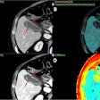 A 61-year-old man with colorectal cancer had a routine CT follow-up exam. (A) Conventional image shows incidental finding of gallbladder wall thickening with heterogeneous enhancement of its wall and mild inflammatory changes suspicious of cholecystitis. Spectral maps: iodine overlay map (B), low keV virtual monoenergetic (C), and Z-effective (D). All spectral images improve the assessment of wall enhancement and complications, such as perforation (arrows).