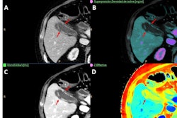 A 61-year-old man with colorectal cancer had a routine CT follow-up exam. (A) Conventional image shows incidental finding of gallbladder wall thickening with heterogeneous enhancement of its wall and mild inflammatory changes suspicious of cholecystitis. Spectral maps: iodine overlay map (B), low keV virtual monoenergetic (C), and Z-effective (D). All spectral images improve the assessment of wall enhancement and complications, such as perforation (arrows).